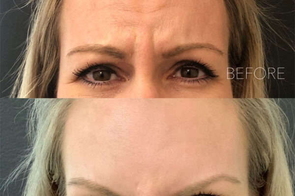 ne-ba-botox-12b A woman's face before and after getting botox in Redlands, CA at Natural Elegance Beauty.