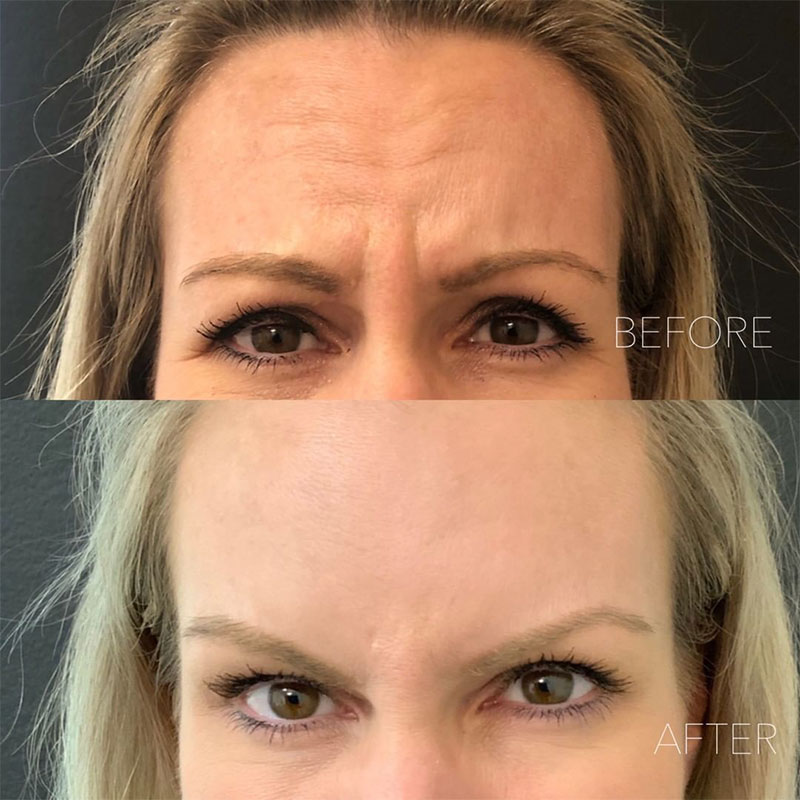 woman before and after Botox after Redlands