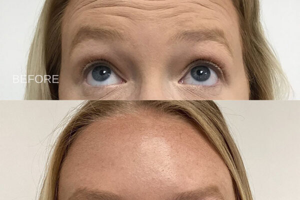 ne-ba-botox-28a A woman's face before and after getting botox in Redlands, CA at Natural Elegance Beauty.