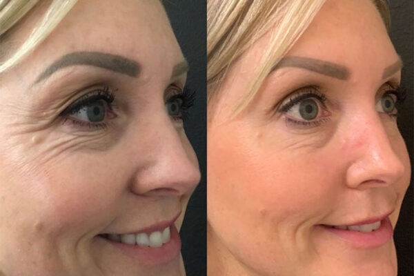 ne-ba-botox-8b A woman's face before and after getting botox in Redlands, CA at Natural Elegance Beauty.