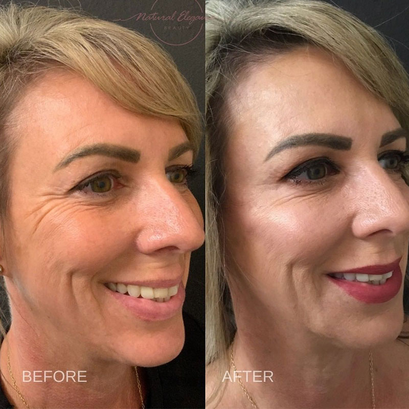 before and after woman receiving Juvederm in Redlands