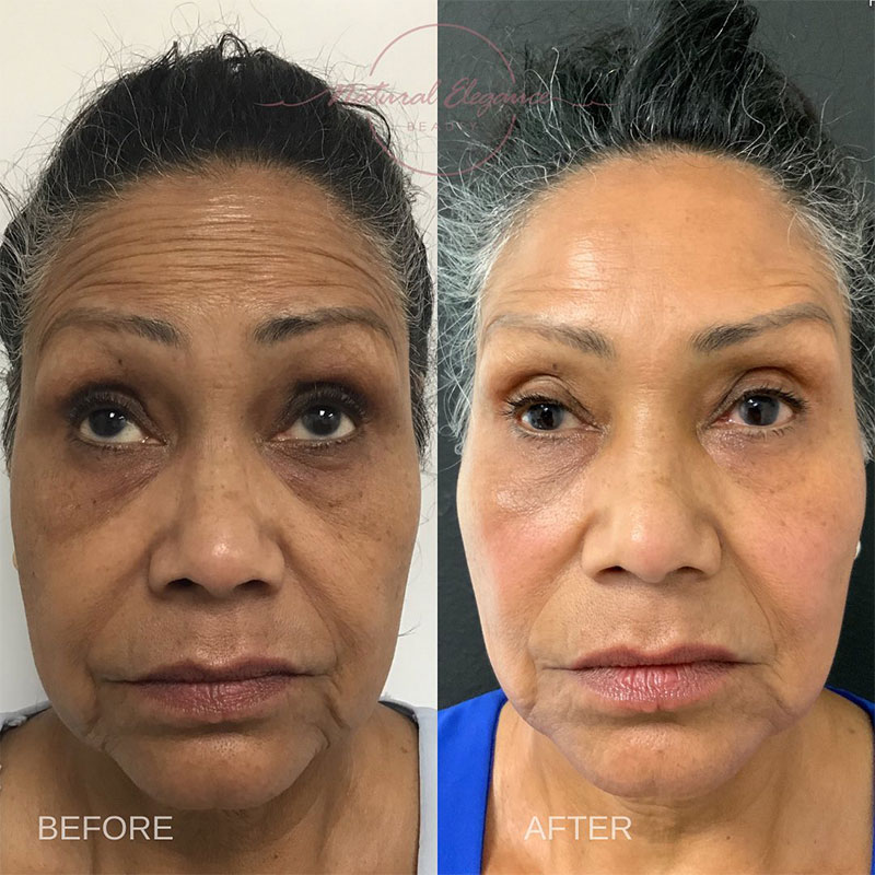 woman before and after liquid facelift in redlands