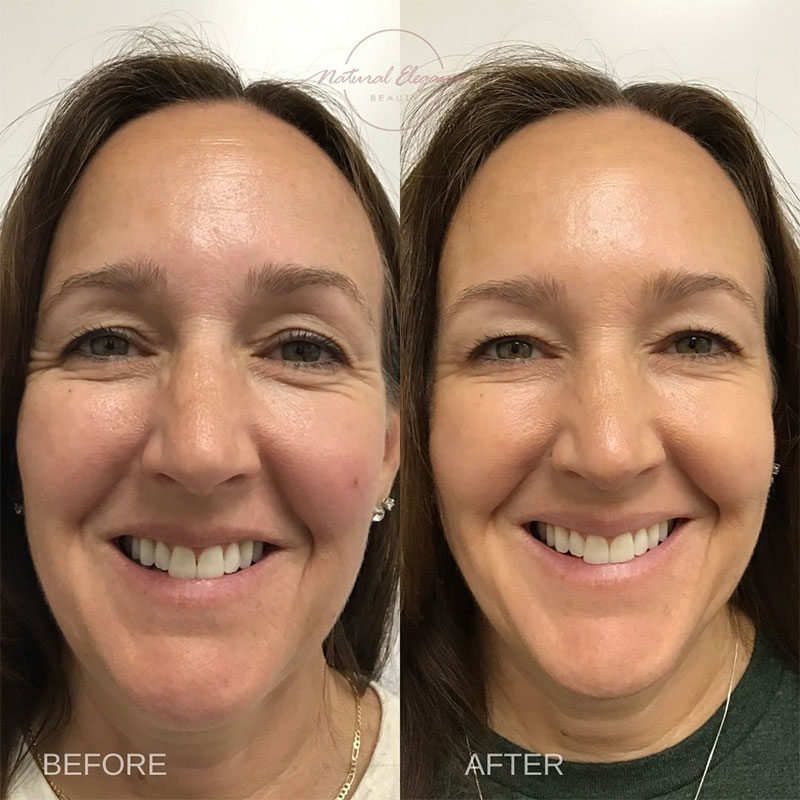 woman before and after Jeuveau in Redlands