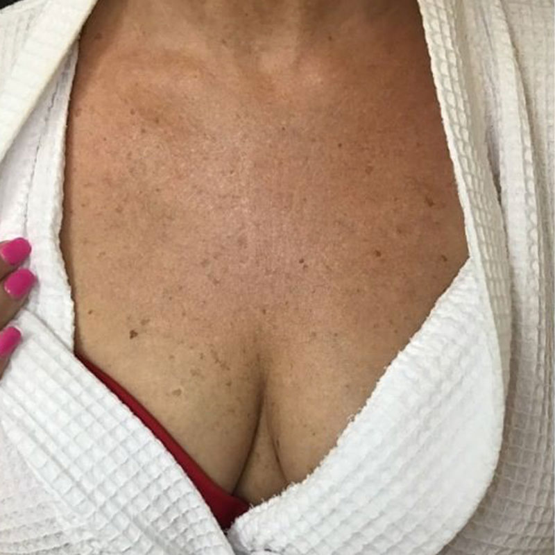 Woman's skin before Laser Genesis treatment in Redlands, CA
