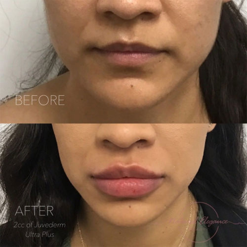 Lip Fillers in Redlands, CA Natural Elegance Beauty