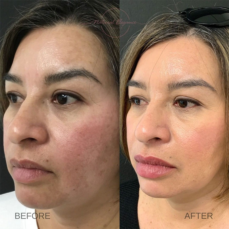 woman before and after dysport in redlands
