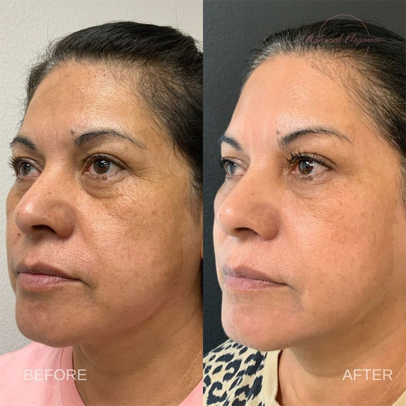 woman before and after dysport in redlands
