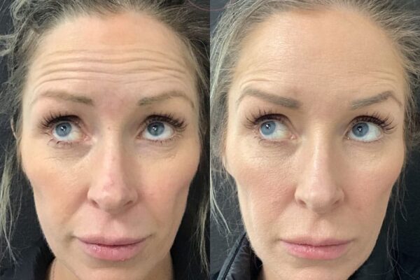 botox-3-1 A woman's face before and after getting botox in Redlands, CA at Natural Elegance Beauty.