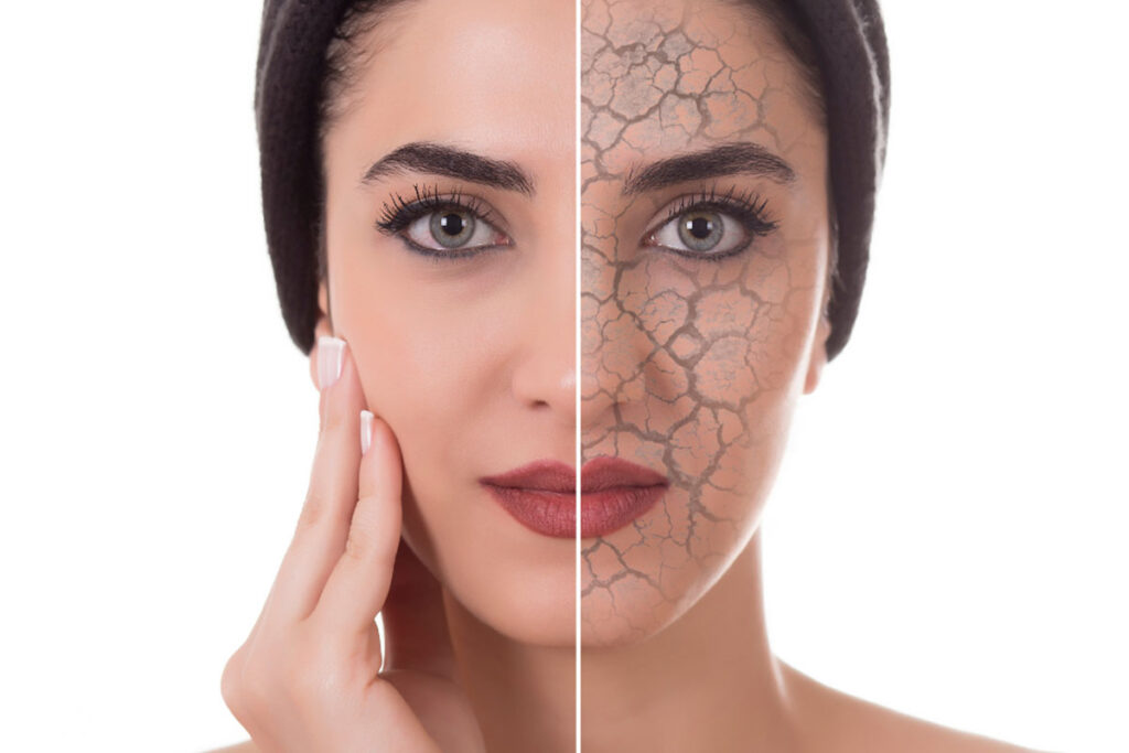 Combat Dry, Winter Skin this Season Three Skin Treatments to Achieve